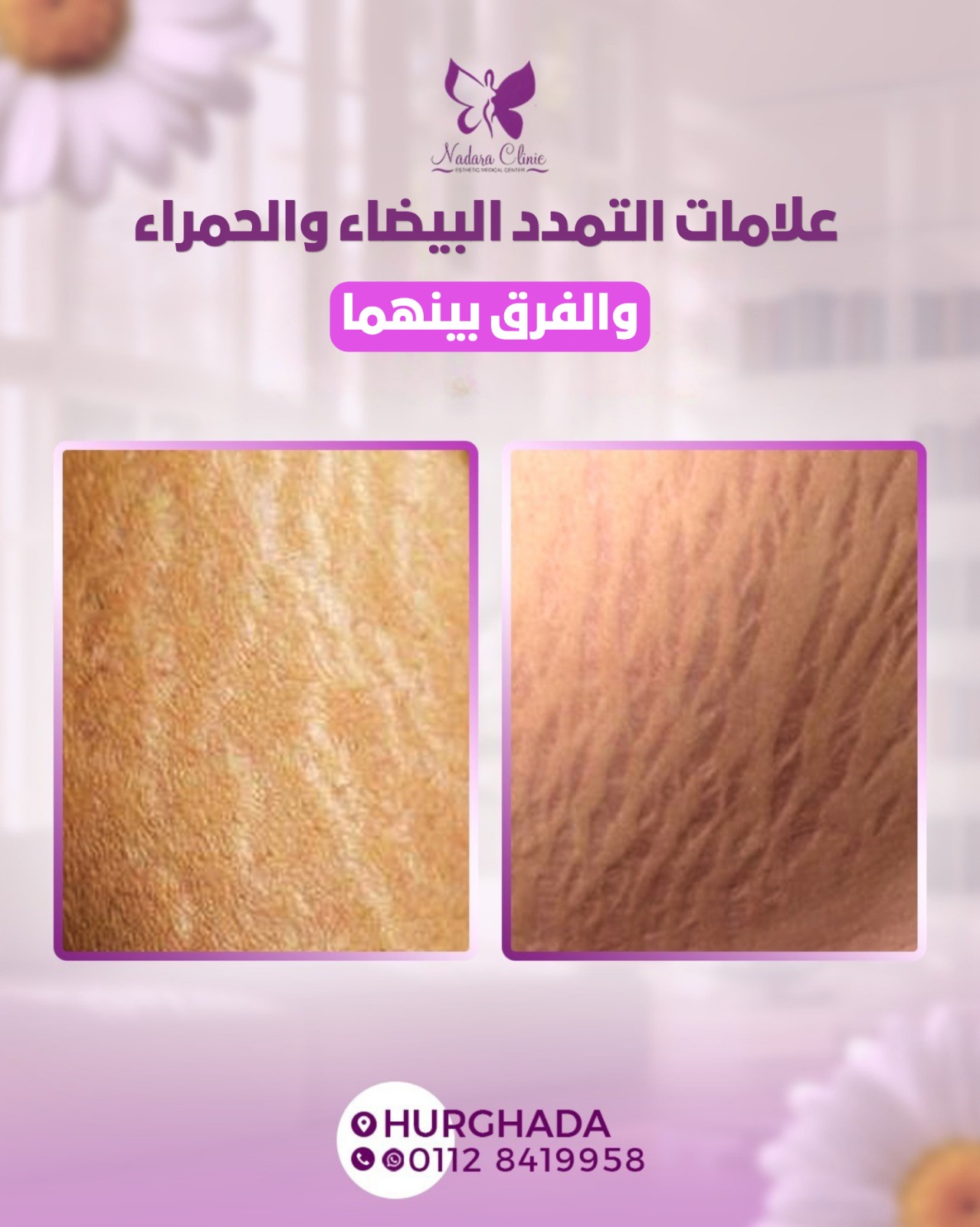 علامات التمدد البيضاء والحمراء والفرق بينهما في الغردقة